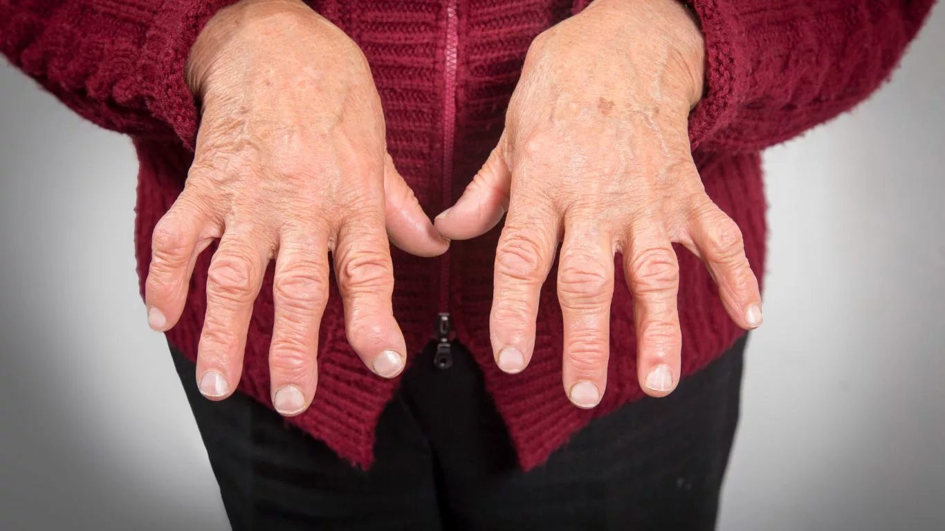 Treatment Options for Rheumatoid Arthritis