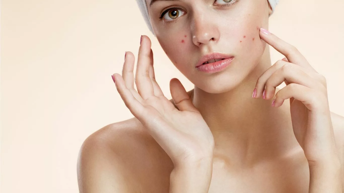 Achieving Clear and Healthy Skin Through Targeted Acne Prevention