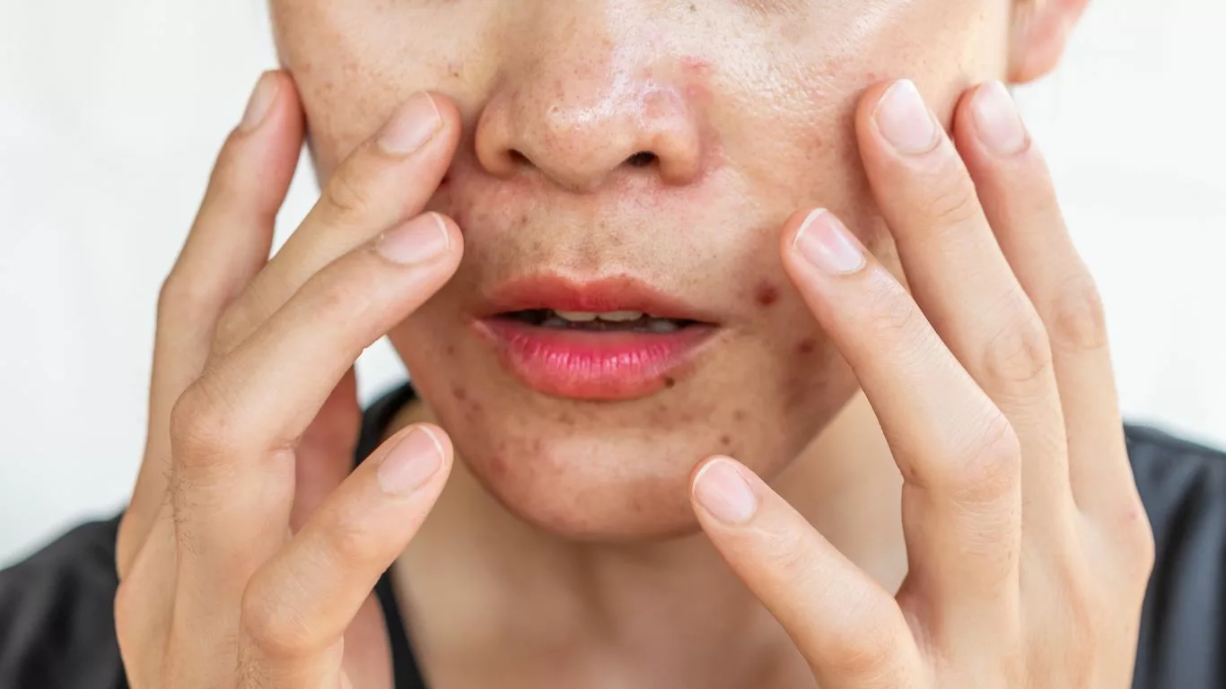 Embracing Natural Solutions for Hormonal Acne