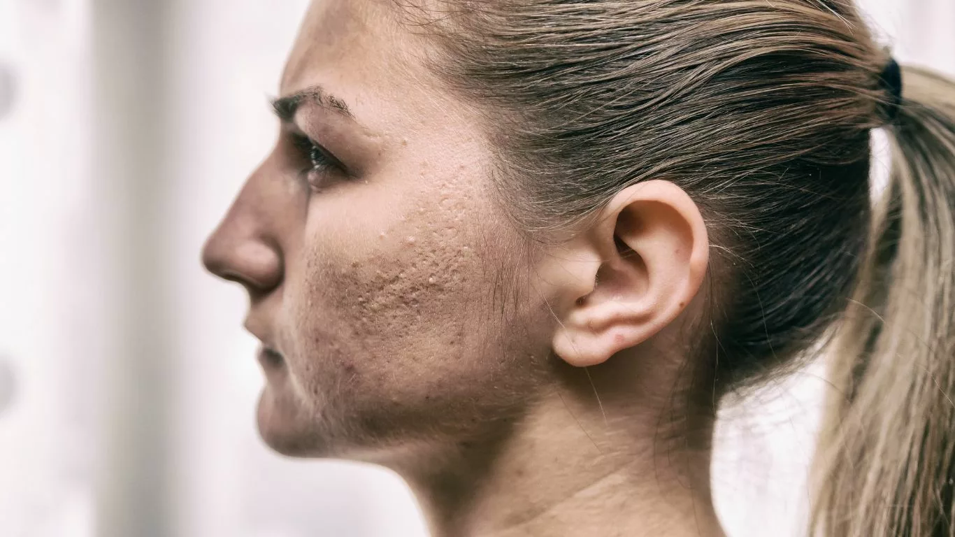 Expert Insights on Acne Scar Treatment