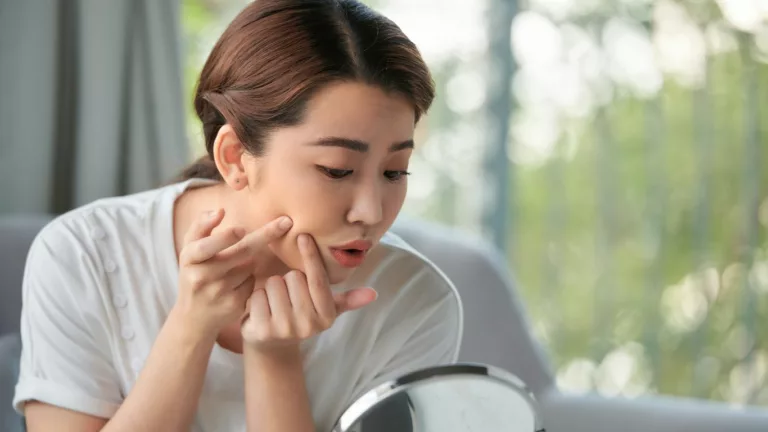 Non-Comedogenic Skincare Routine for Acne-Prone Skin