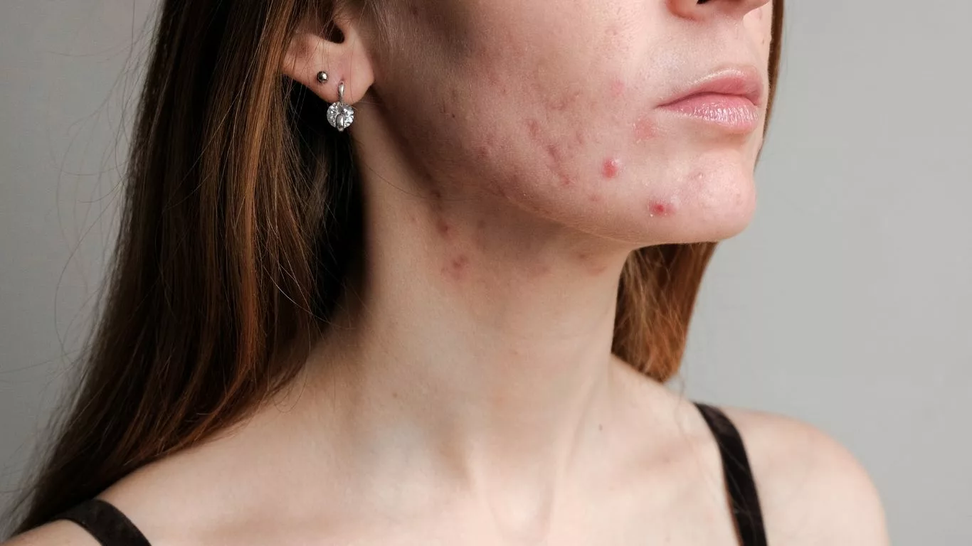 The Impact of Acne Scars