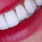 Enhance Your Smile with Emax Porcelain Veneers