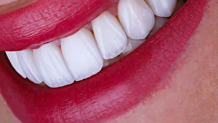 Enhance Your Smile with Emax Porcelain Veneers