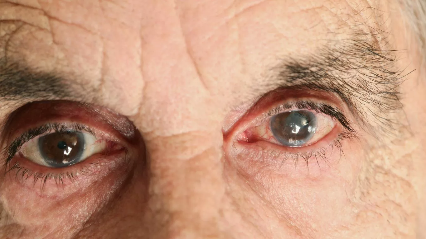 Possible Causes of Eye Floaters After LASIK Surgery