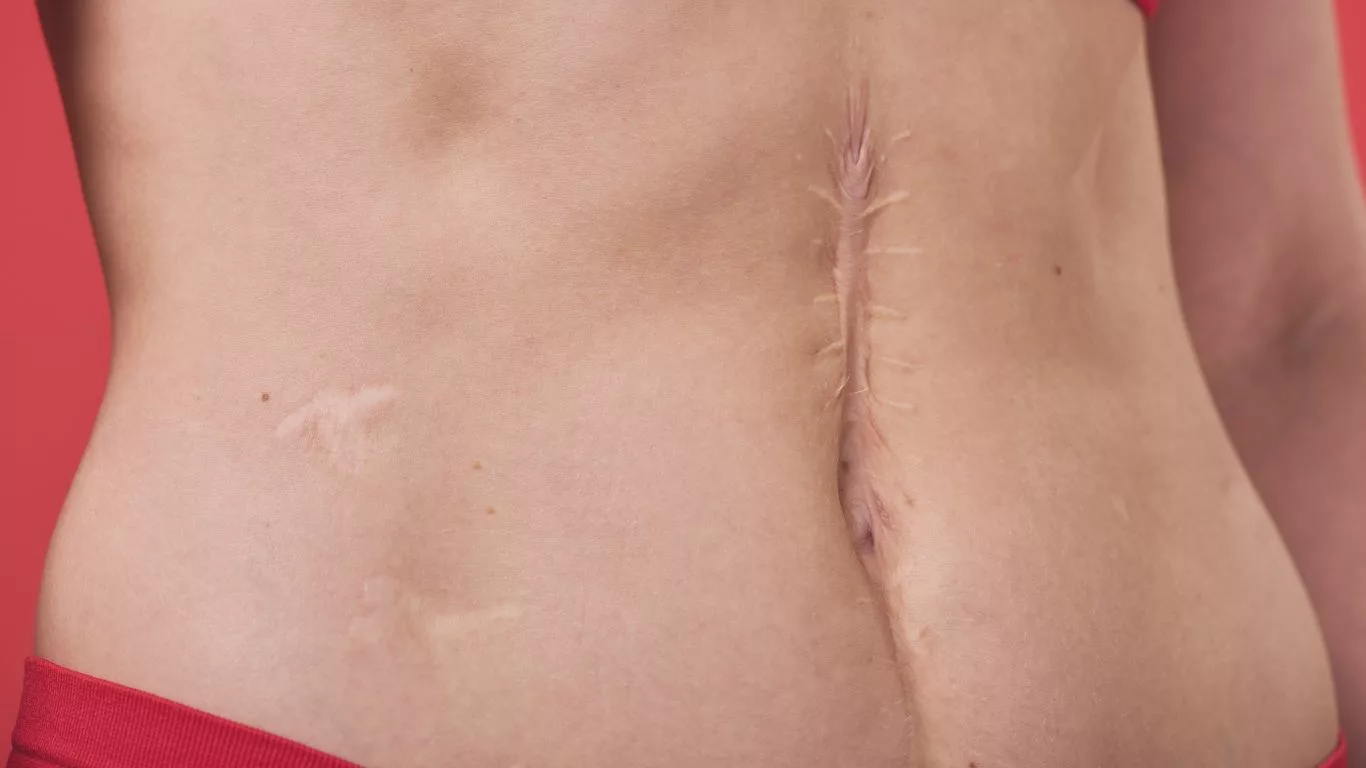Factors Influencing Scar Formation after Liposuction