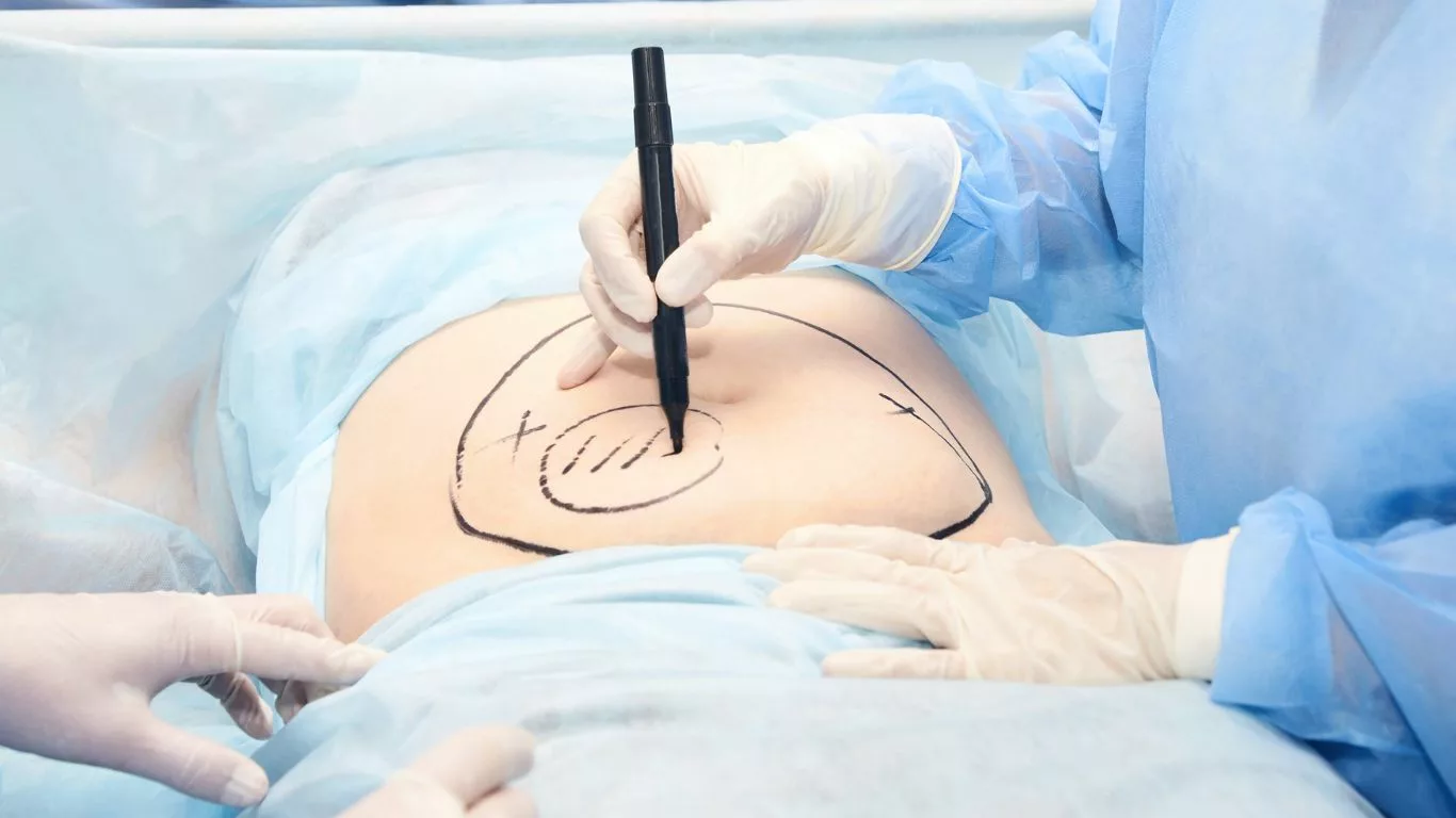 Is Liposuction Without Tummy Tuck Effective? - Exploring Options