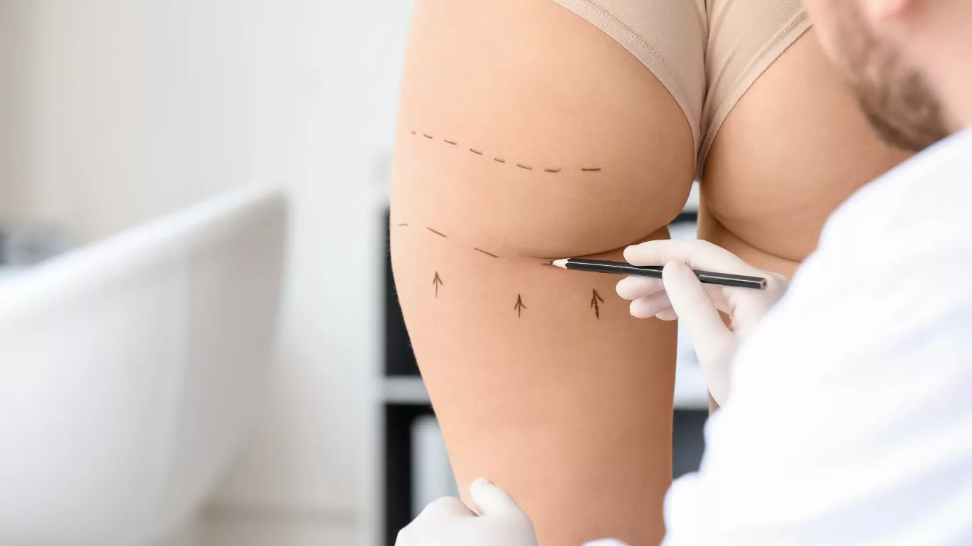 The Butt Liposuction Procedure