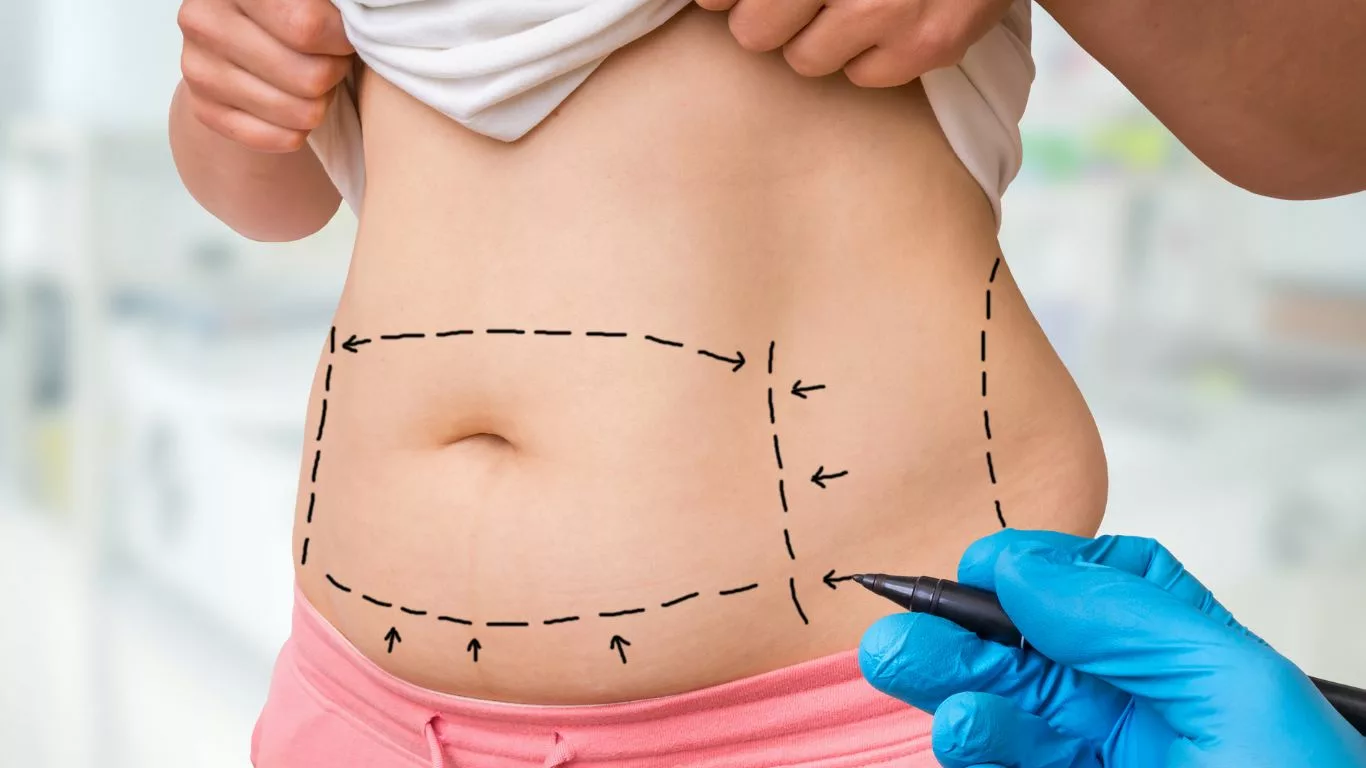 Benefits of Liposuction Without Tummy Tuck