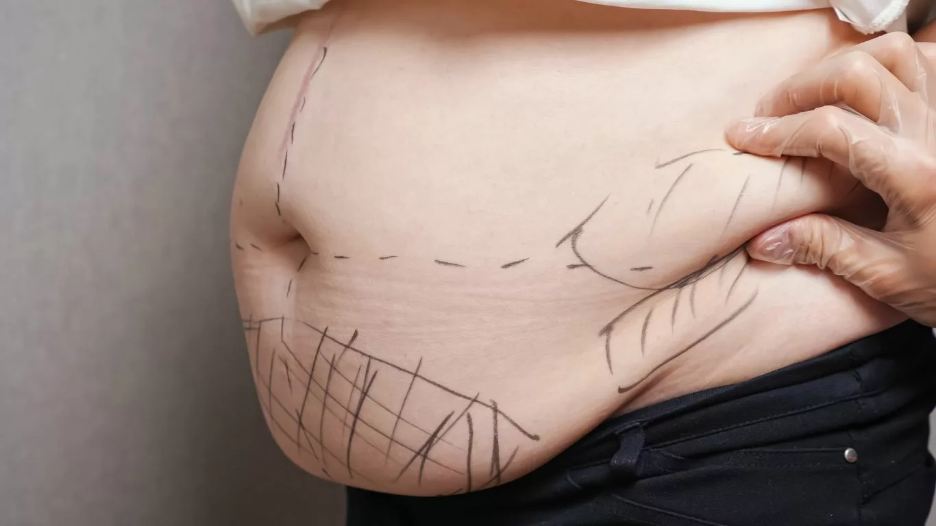 Understanding Liposuction and Scarring