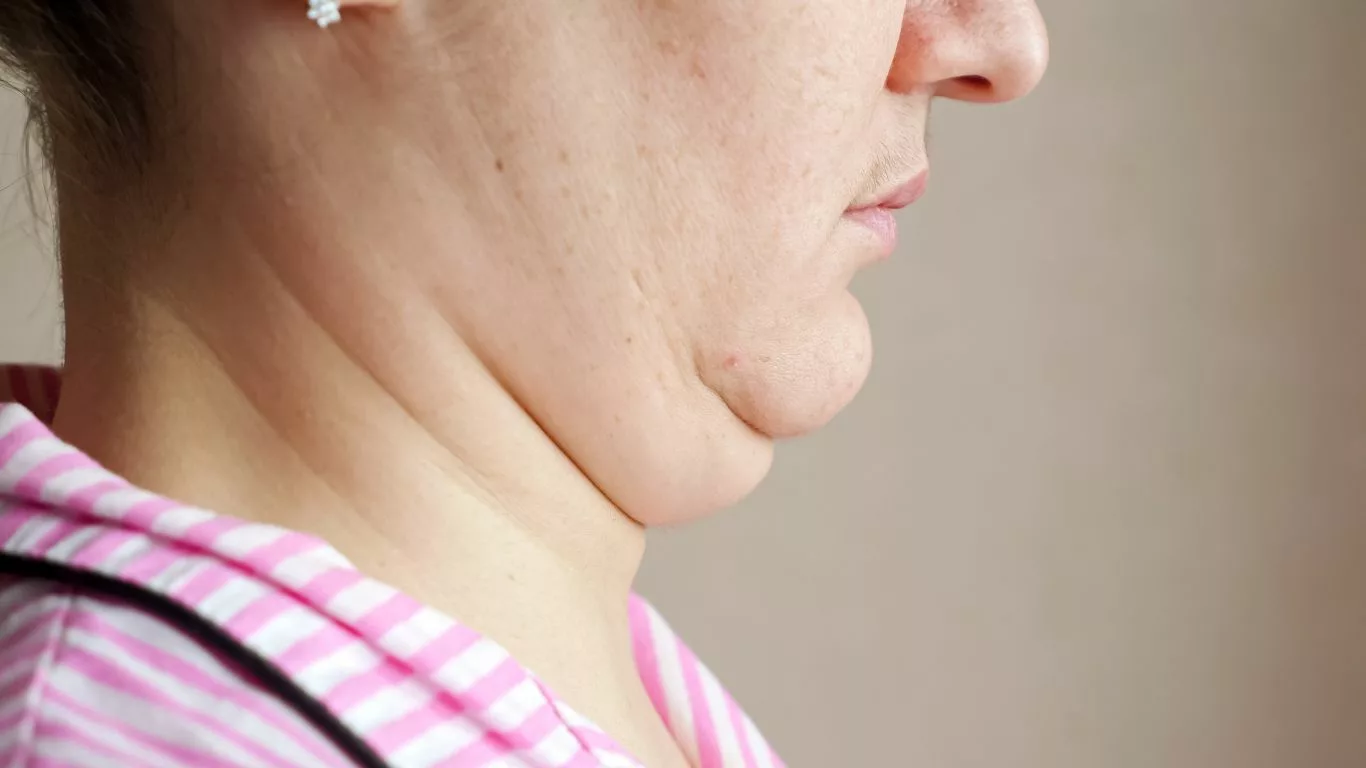 Understanding Liposuction for Double Chin Reduction