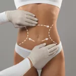Understanding the Average Cost of Stomach Liposuction