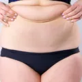 Liposuction Cost: What You Need to Know