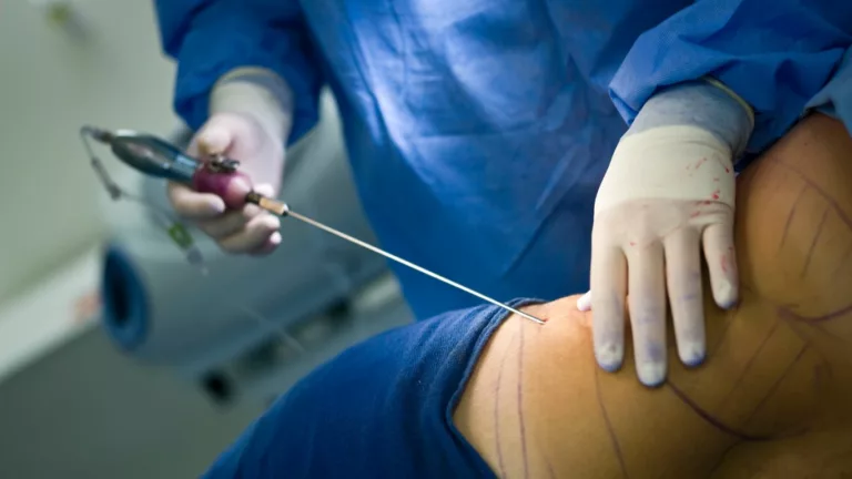 Does Liposuction Hurt? Understanding the Pain Factors