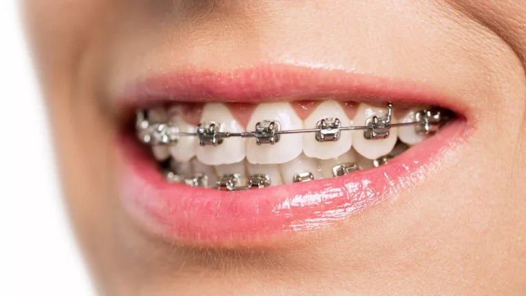 Can You Eat Chips with Braces? – A Crunchy Dilemma