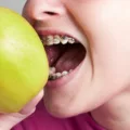 Best Foods to Eat with Braces: Top Choices for Comfort and Health