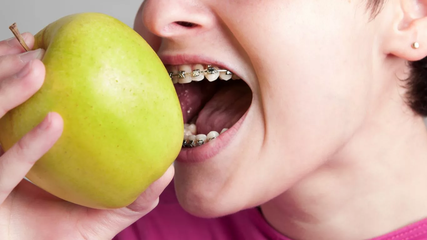 Best Foods to Eat with Braces: Top Choices for Comfort and Health