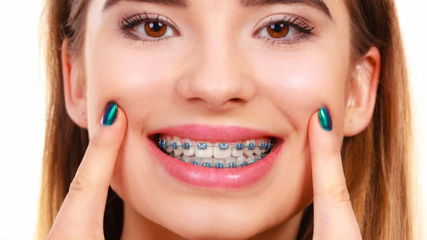 Why Food Choice Matters with Braces