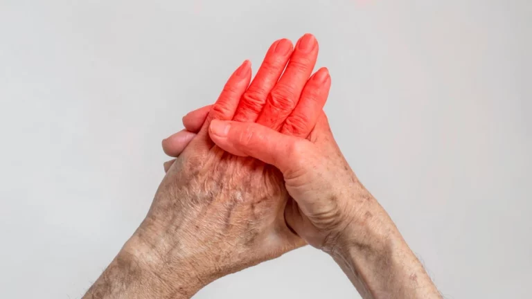 Rheumatoid Arthritis and Kidney Health: What You Need to Know