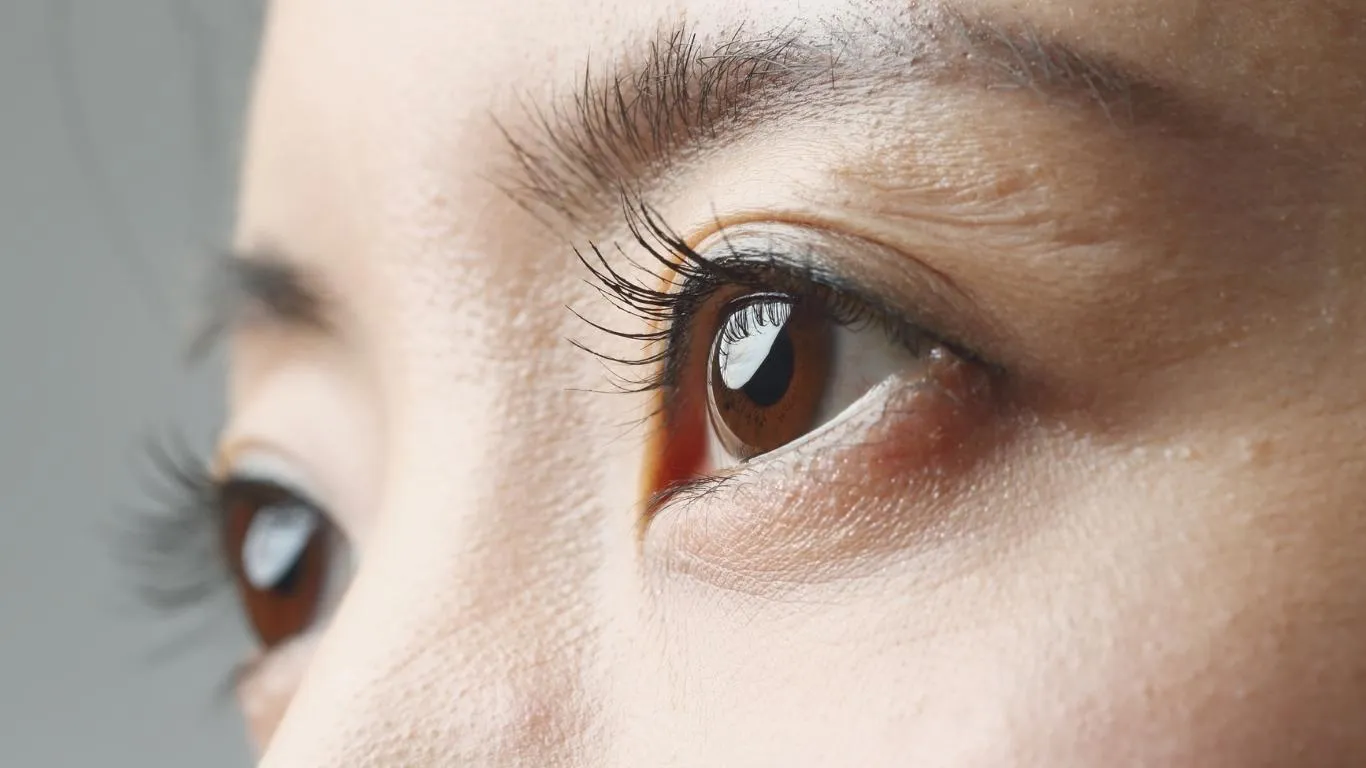 Eye floater causing visual discomfort