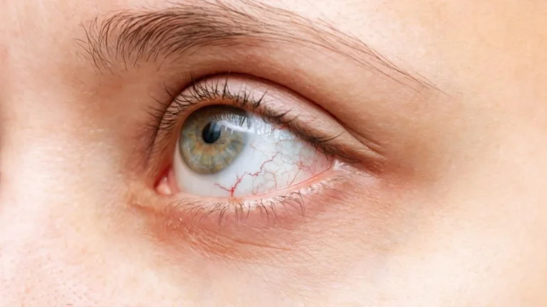 Why Floaters Appearing During Vision Board Creation Feel Distracting