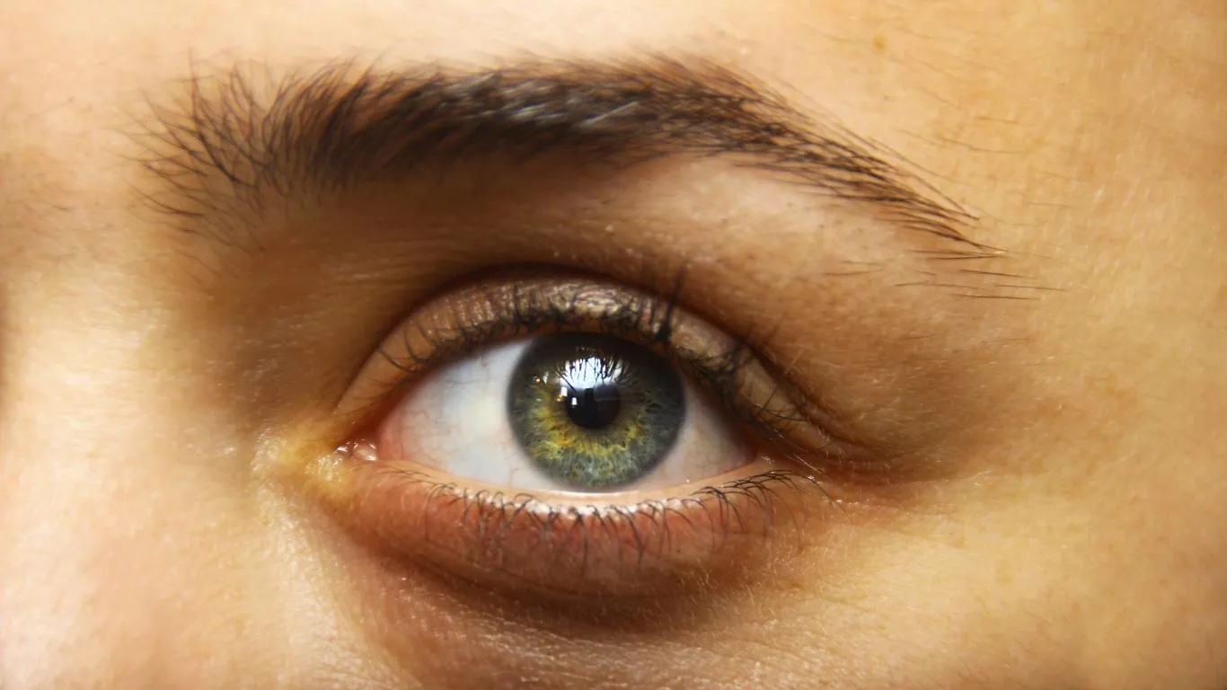 Illustration of vitreous fibers clumping together in the eye